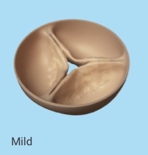 A model of mild stenosis (thickening and stiffening of valve cusps) of the aortic valve of the heart