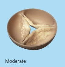 A model of moderate stenosis (thickening and stiffening of valve cusps) of the aortic valve of the heart