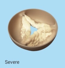 A model of severe stenosis (thickening and stiffening of valve cusps) of the aortic valve of the heart
